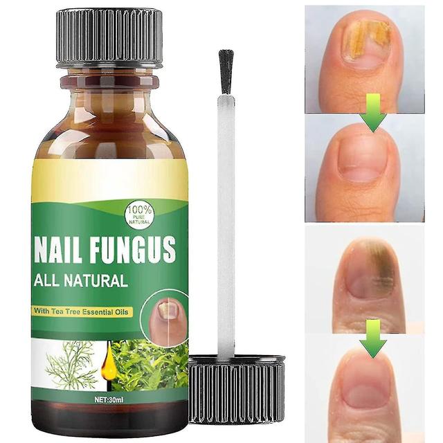 30ml Toe Fungus , Tea Tree Oil For Toe Fungus, Anti Solut Care Tw on Productcaster.