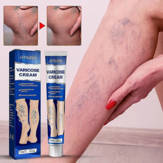 Shihaodian Jaysuing Varicose Vein Massage Varicose Cream Repair Leg Blood Vessel Bumps Swollen Earthworm Varicose Cream Vein Health Cream on Productcaster.