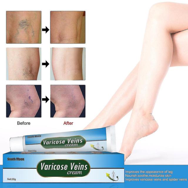 Youlaicai Intravenous Massage Gel,earthworm Leg Vein Blue Veins Protruding Varicose Paste 20g on Productcaster.