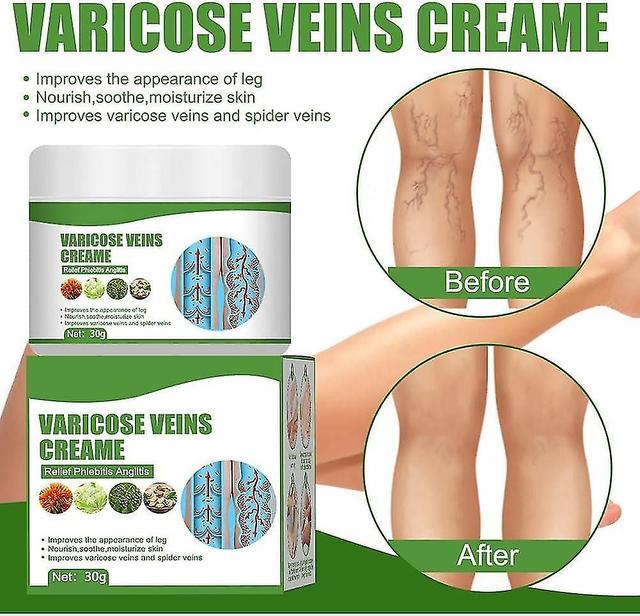 Creme de varizes, creme de varizes para pernas, eliminar varizes e veias, aliviar a dor e coceira das pernas 2 Pcs on Productcaster.