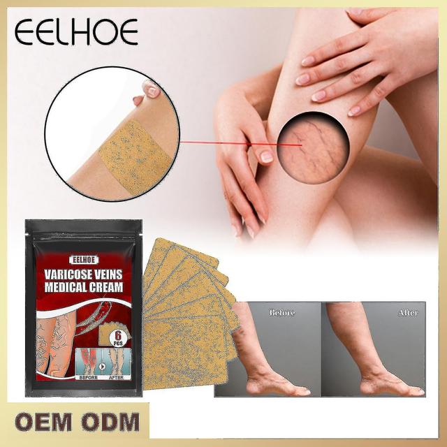 Eelhoe Varicose Vein Massage Plaster Swollen Leg Earthworm Leg Vein Massage Pain Relief 6pcs Bx on Productcaster.