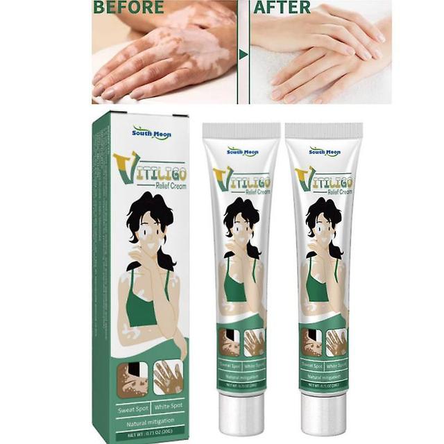 2x Extrato de ervas pomada vitiligo remover micose Remoção de manchas brancas pele vitiligo eliminar vitiligo creme de tratamento on Productcaster.