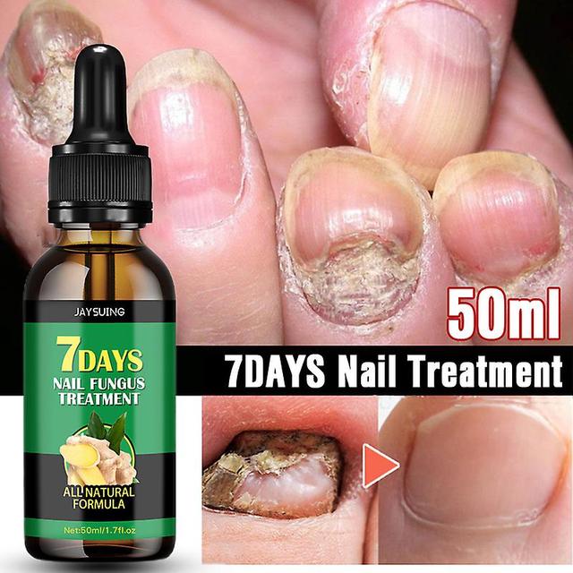 Antifungal Treatment Of Nails For Feet Care, Anti-betection Essence, Paronyamitity, Onychomycosis, Mushroom Elimination Gel, 7-day Video 10ml on Productcaster.