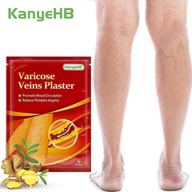 6 Stück = 1 Beutel Krampfadern Pflaster Entlastung Bein Vaskulitis Phlebitis Angiitis Besenreiserschmerzen Pflanzliches medizinisches Pflaster Körp... on Productcaster.