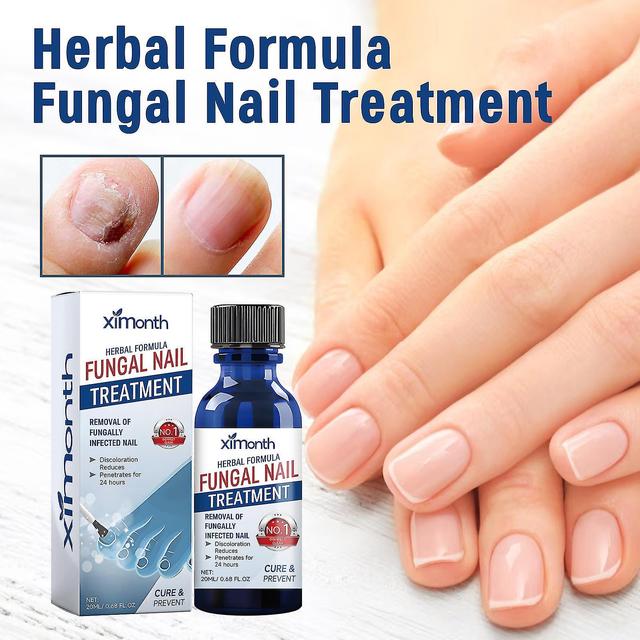 Herbal Formula Fungal Nail Paronychia Treatment Gel, Toenail Fungus Treatment, Extra Strength Repair Solution Fingers And Toenails_Feb 1pcs on Productcaster.