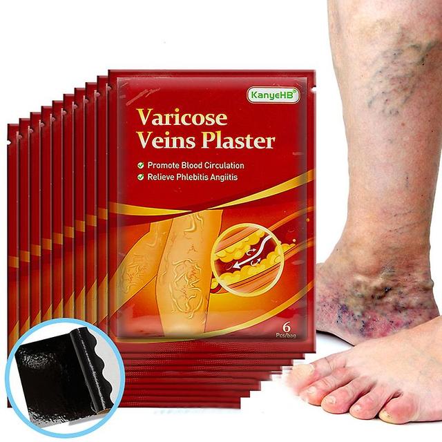 Qian 18pcs Varicose Veins Ointmnet Vasculitis Phlebitis Spider Cream Varicosity Angiitis Removal Herbal Medical Plaster Health Care 6pcs in 1 bags on Productcaster.