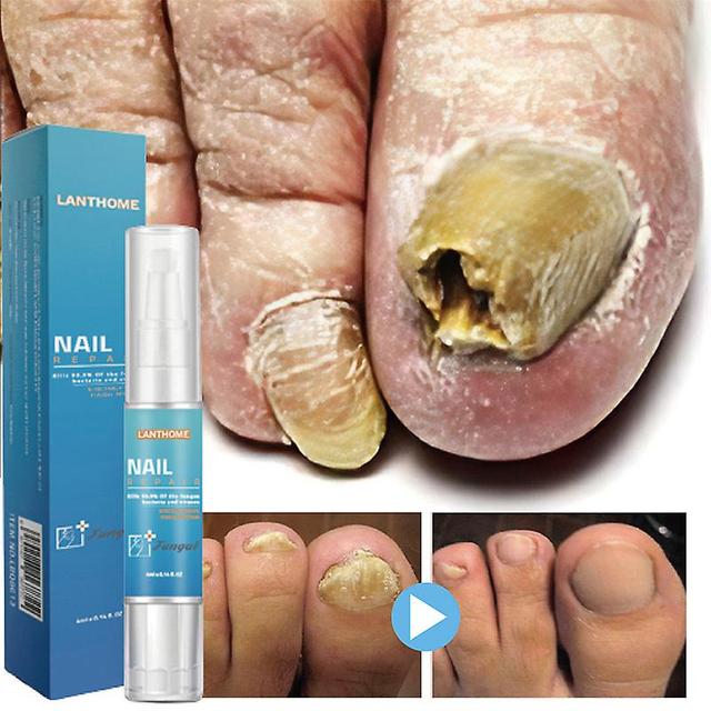 Antifungal Treatment Of Nails, Fuel Pen, Anti-betection, Paronyamitity, Onychomycosis, Foot, Mushroom Elimination, Gel, Product Care Product on Productcaster.