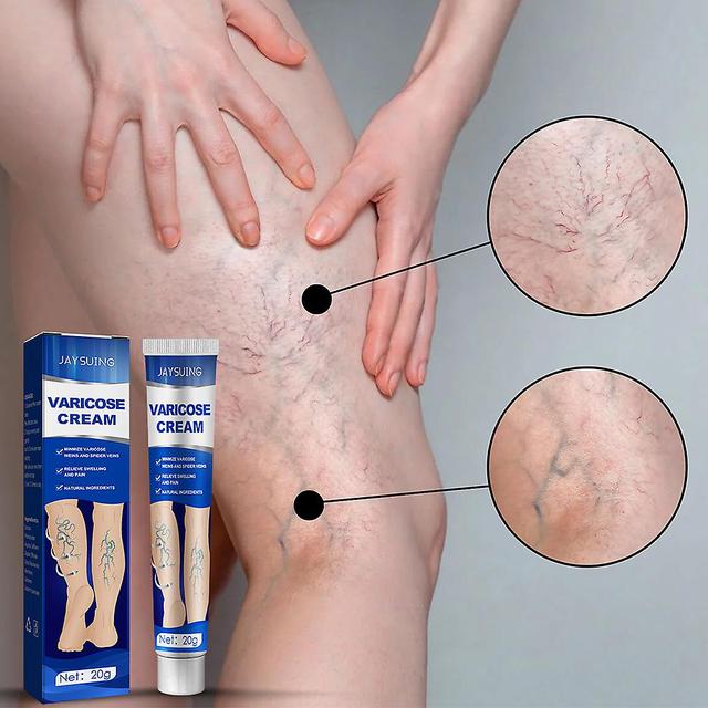 Varicose Vein Cream for Blood Vessel Swelling Leg Raised Vasculitis Phlebitis on Productcaster.