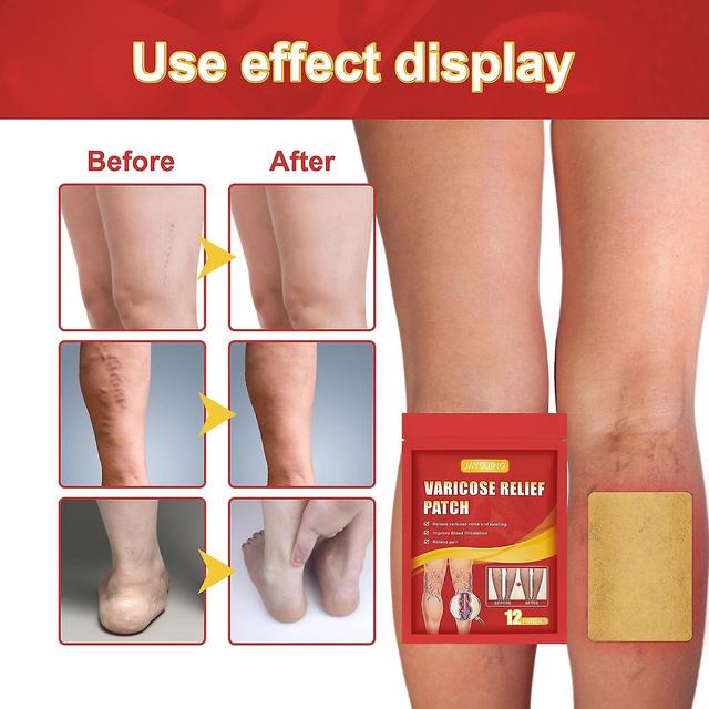 36pcs Vein Plasters - Varicose Veins Stickers, Varicose Veins Care, Helps Reduce The Appearance Of Varicose Veins And Spider Veins on Productcaster.