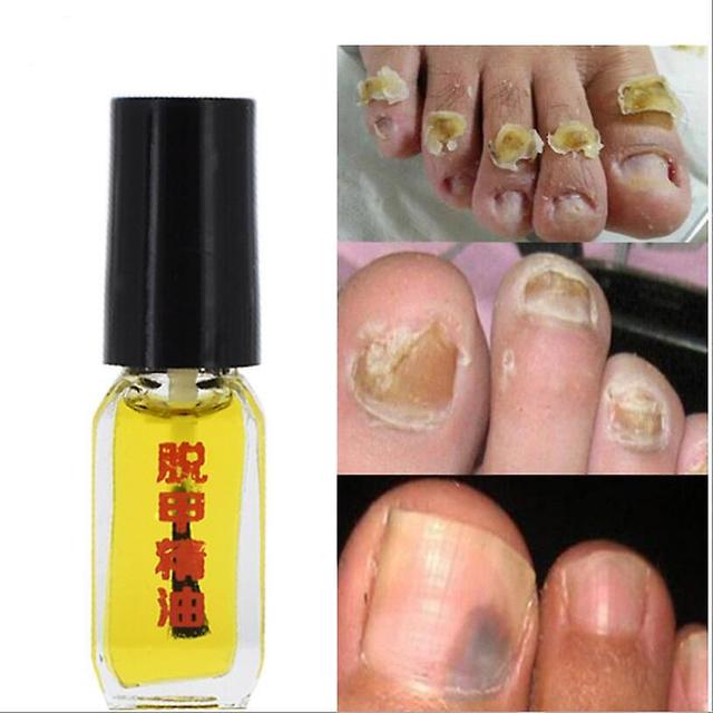 DeliaWinterfel Anti Fungal Nail Infection Toenail Oil on Productcaster.