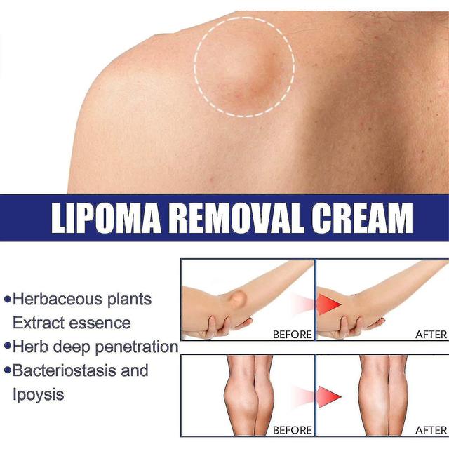 Lipoma Removal Cream Herbal Extract Care Fat Bulges Lump Remove Subcutaneous Lump Relief Swelling Fat Elimination Cream 20g on Productcaster.