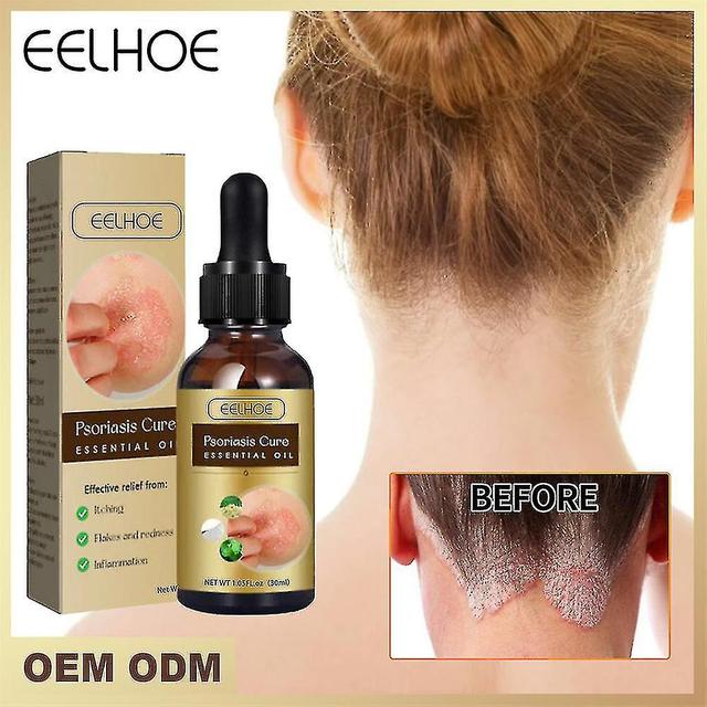 Eelhoe Psoriasis Repair Essential Oil on Productcaster.