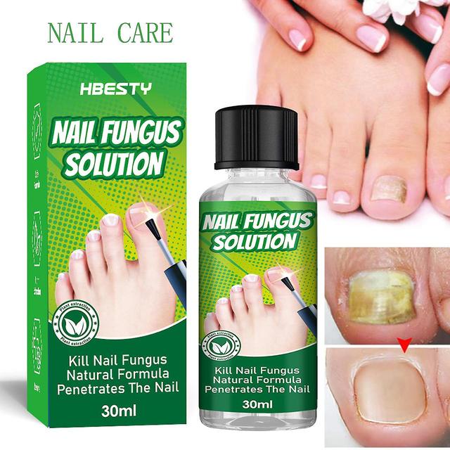 Cloud Xiang Nagelpilz-Reparaturflüssigkeit Klinisch nachgewiesene sichere Inhaltsstoffe 30 ml Flüssigkeit zur Bekämpfung von Nagelbakterien on Productcaster.