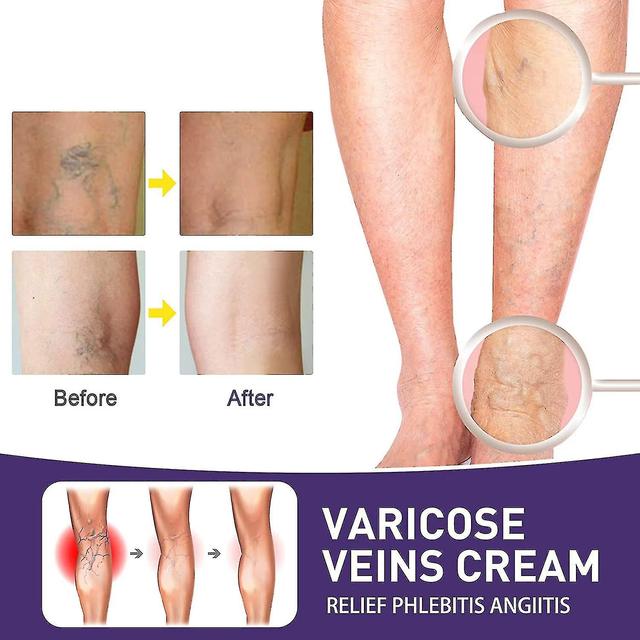 Tmall Varicose Vein Cream, Relief Of Leg Varicose Veins, Strengthening Capillary Health, Spider Vein Care Cream 1pcs on Productcaster.