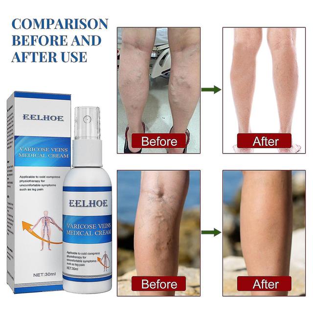 Vein Massage Varicose Vein Spray Soothes Veins, Soothes Worm Legs, Relieves Leg Blood Vessel Pain on Productcaster.