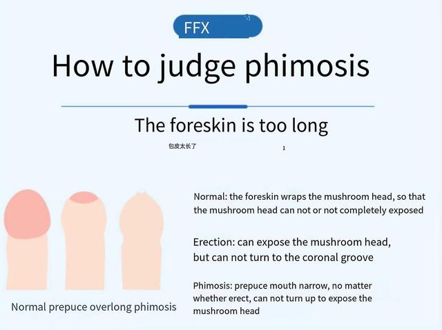 Male prepuce gel male prepuce block compound fluid phimosis orthotic on Productcaster.