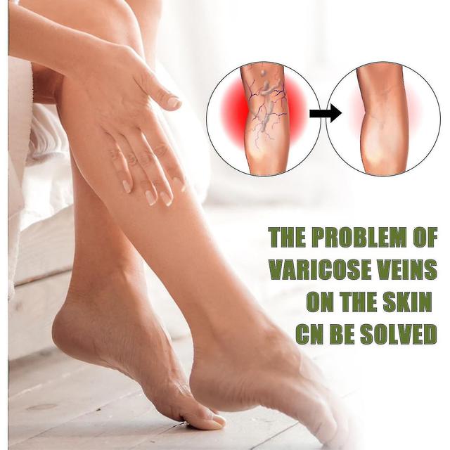 Aoui Eelhoe Vein Massage Leg External Use Blue Vein Bulge To Relieve Pain And Reduce Red Blood Varicose on Productcaster.