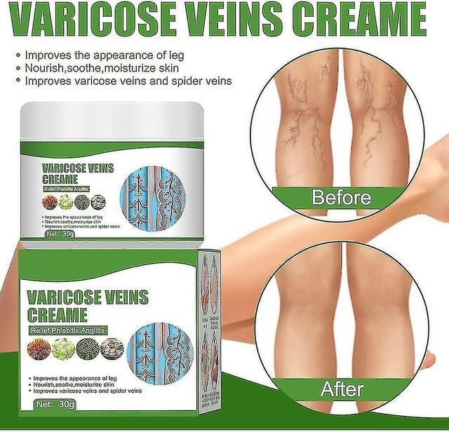 Varicose Veins Cream,varicose Vein Cream For Legs,eliminate Varicose Veins And Spider Veins,relieve Pain And Itching Of Legs 2 Pcs on Productcaster.