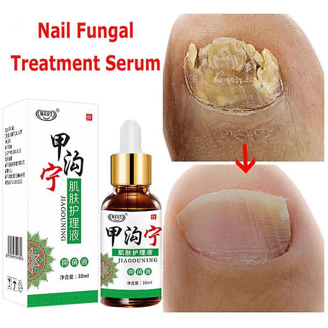 Essence Of Nail Fungi, Feet Care, Feet Repair, Parker, Anti-infectious Gel, Paronyamionychomycosis, N64. 5PCS on Productcaster.