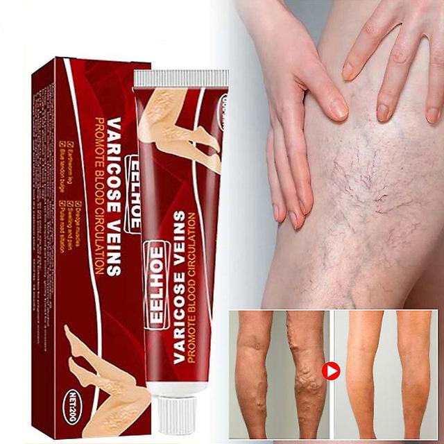 Crème Des Instituts De Varices À Base De Plantes, Vascularite, Phlébite, Araignée Oto, Pommade Des Instituts, Plâtre D’Herbes, Beauté, Corps, Jambe on Productcaster.