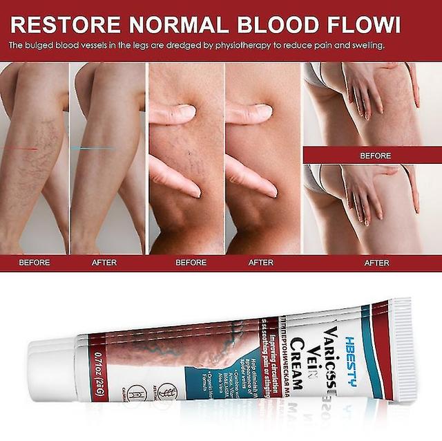 Hbesty Vein Repair Cream Russian Leg Meridian Vein Relaxation Care Cream Leg Antipyretic Gel Hk on Productcaster.