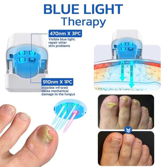 2024 Nouveau, ongle Fungus Laser Dispositif Thérapie par la lumière Traitement des orteils d’onychomycose 910nm, 50% Offre on Productcaster.