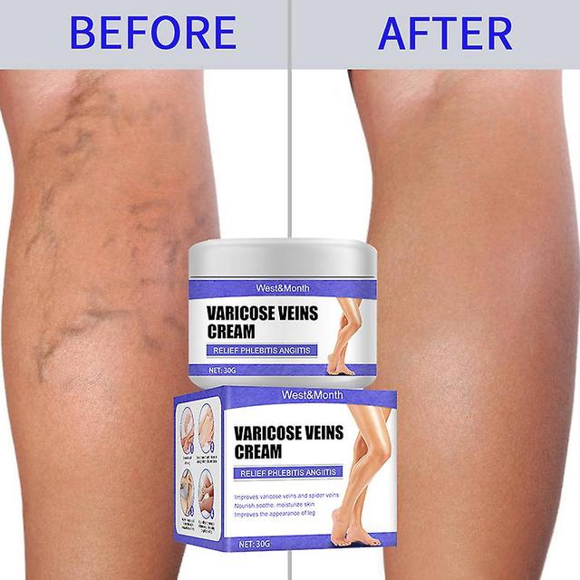 Efficient Cream For Varicose Veins, 30g 30ml on Productcaster.