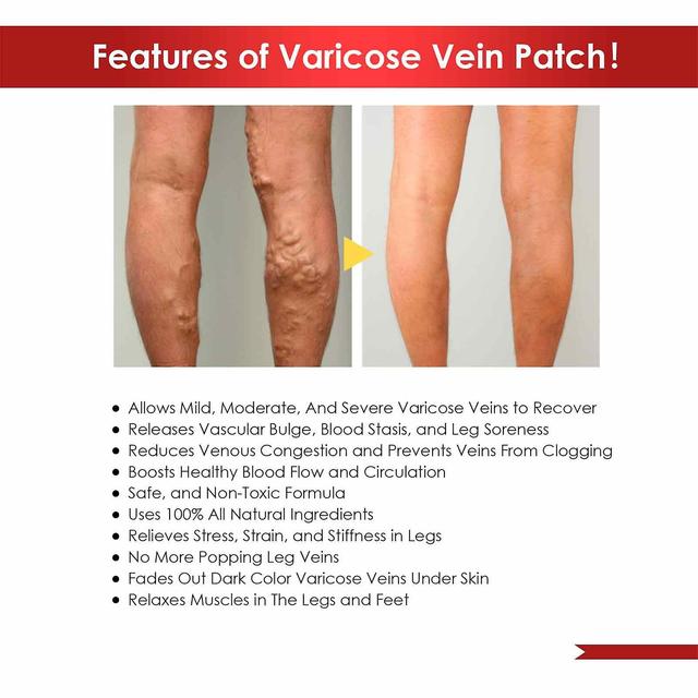 Finiss Varicose Vein Patch Phlebitis Chinese Herbal Plaster 6pcs adulto Spider Vein Removal Patches Sticker per gambe Leg Care on Productcaster.