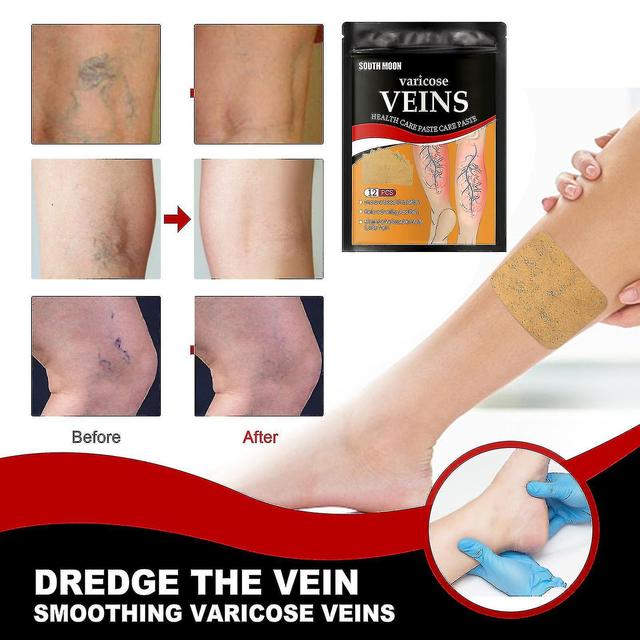 Shihaodian South Moon Vein Health Patch Relieve Varicose Blood Vessels In The Feet Hk on Productcaster.