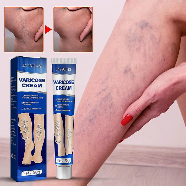 Cdls Jaysuing Varices Massage Varices Crème Réparation Jambe Vaisseaux sanguins Bosses Gonflé Ver de terre Crème Variqueuse Crème Santé Veine, on Productcaster.