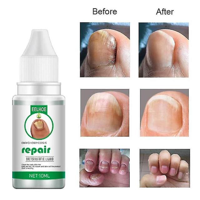 Nails Repair Essence Liquid Nail Renewal Liquid Solution Repair Strengthen Excellent high quality on Productcaster.