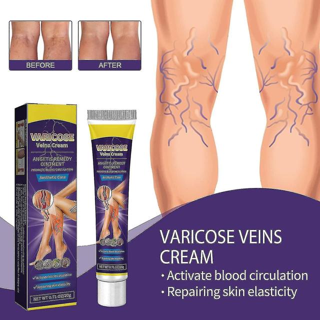 Crème pour varices, Soulagement des varices de jambe, Renforcement de la santé capillaire, Crème de soin des veines d’araignée 2Pcs on Productcaster.