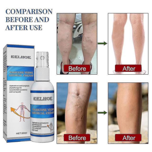 Eelhoe Vein Massage Varicose Vein Spray Alivia las Venas, Alivia las Piernas de Gusano, Alivia los Vasos Sanguíneos de las Piernas on Productcaster.