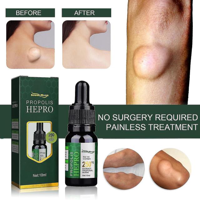 Herbal Lipoma Removal Oillipolysis, massa verlichten essence, verlichten massa, 10ml on Productcaster.