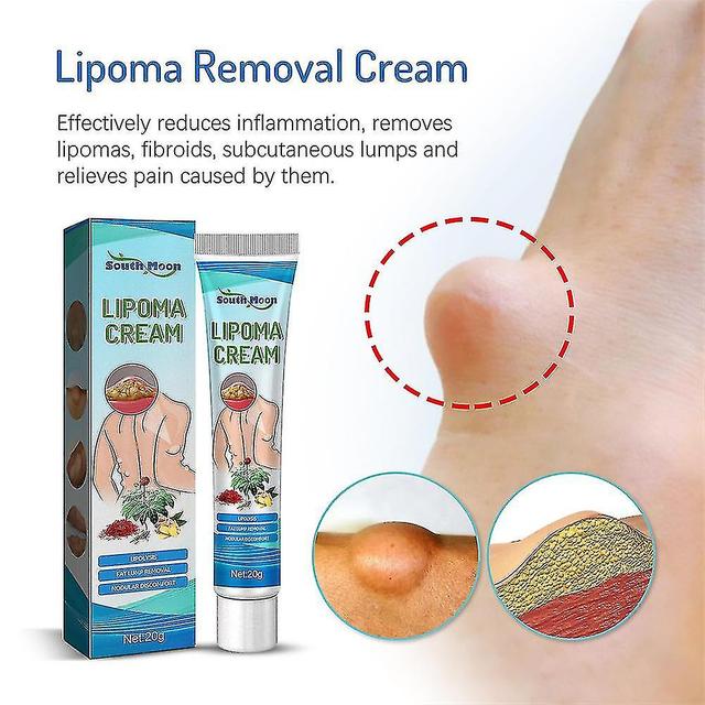 Højkvalitets 2x Ny Lipoma Removal Cream Lipoma Treat Skin Hævelse Delipidation Cream on Productcaster.