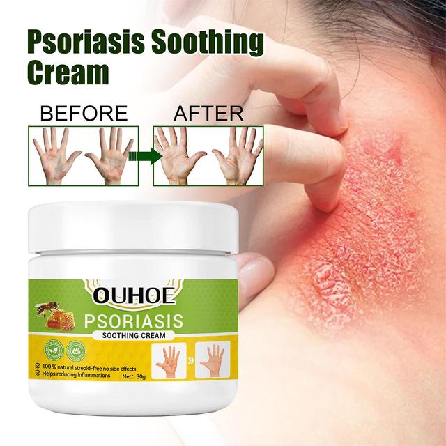 30g Psoriasis Repair Cream Skin Allergic Wet Itching Relief Cream for Itchy Irritated & Scaling Skin A on Productcaster.