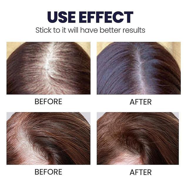 Fast Hair Growth Products Biotin Spray Treatment Of Hereditary Alopecia Postpartum Alopecia Pattern Biotin For Hair Growth on Productcaster.