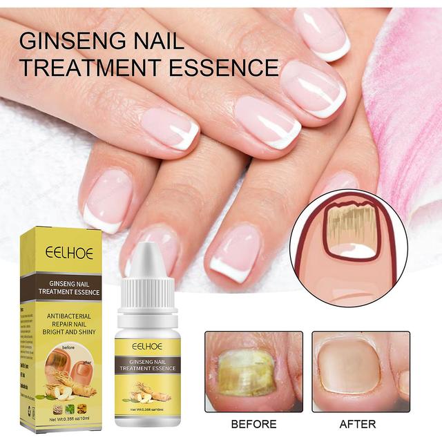 Hongyexin Herbal Nail Óleo Essencial Previne o Crescimento 10ml on Productcaster.