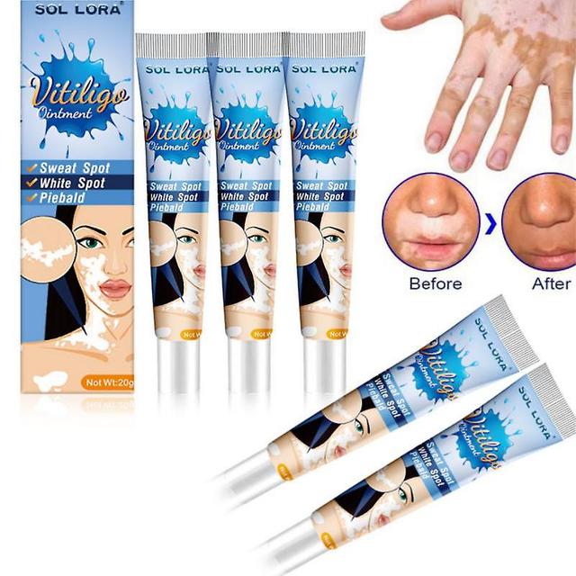 5x Herbal Extrato Vitiligo Pomada Remover Micose Remoção de Manchas Brancas Pele Vitiligo Eliminar Vitiligo Creme de Tratamento on Productcaster.