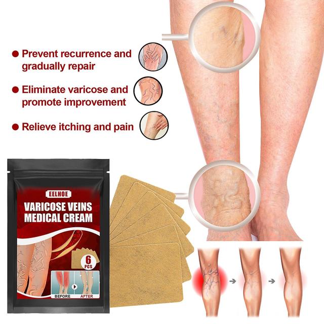 Eelhoe Vein Massage Varicose Plaster Patch Leg Swelling Earthworm Leg Vein Massage Relieve Pain 3PCS on Productcaster.