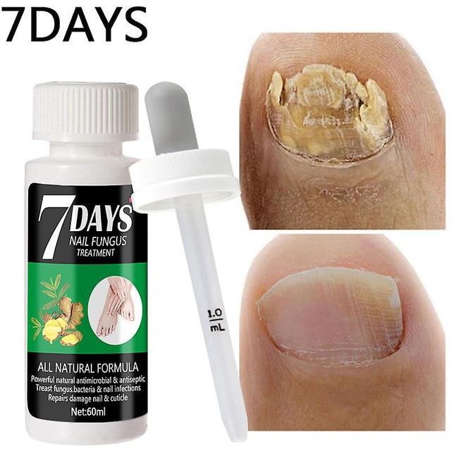 Feet Care Essence For Fungal Treatment, The Best Nails Repair, Prevents The Growth Of Freight, Repairs And Inhabiting It Damaged And Damaged Nails ... on Productcaster.