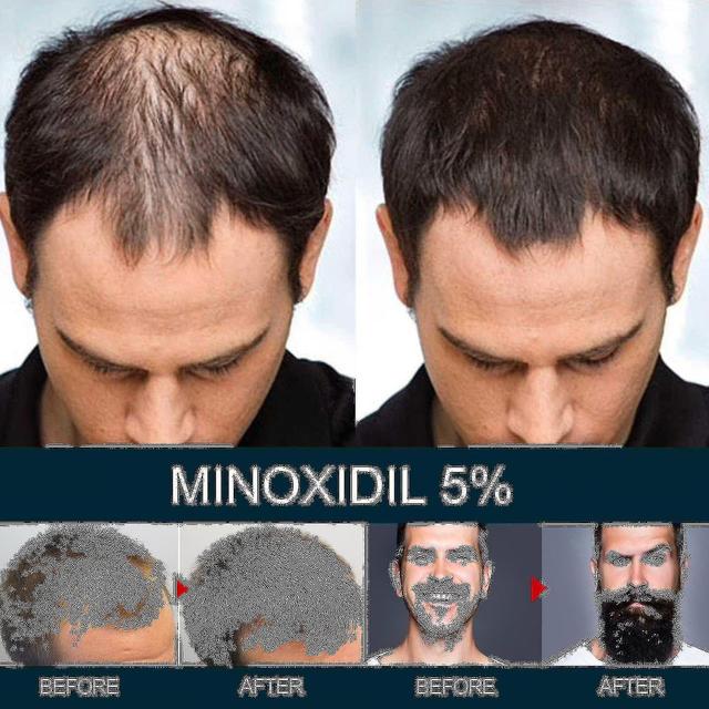 Solución tópica para la pérdida de cabello para hombres con 5% de fuerza extra para el crecimiento del cabello. 2024rui 6 bottles on Productcaster.