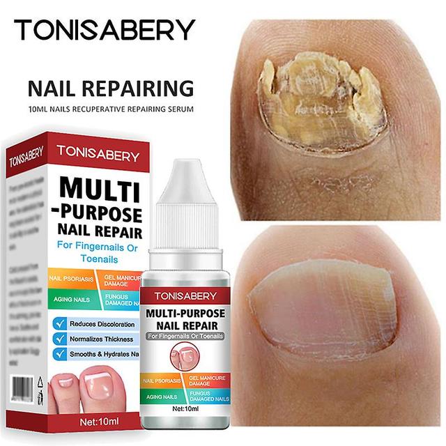 Traitement Des Champignons Pour Sérum Pieds Élimination Gel De Champignons Pour Anti-infection Nail Paronychiacycose Pompes De Réparation Essence T on Productcaster.