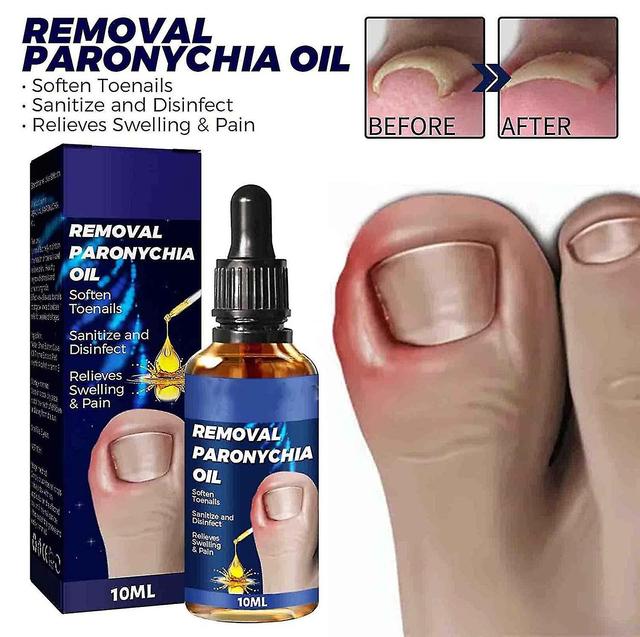 Qinfen Toe Nail Care Removal Paronychia Oil,anti Paronychia Relief Oil,toenail Anti Paronychia Relief Oil For Damaged Discolored Thick Nails 10ml 2... on Productcaster.