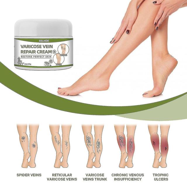 Varicose Vein Cream 50g Varicose Vein Cream Anti-spider Veins And Spider Vein Removal Varicose Veins Leg Care Ointment-niubi on Productcaster.