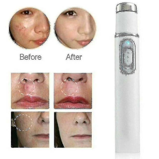 Spider Vein Eraser Blue Light Removal Eraser Erapy Wrinkle Acne Laser Pen Scar on Productcaster.