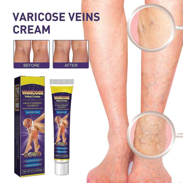 Varicose Veins Cream, Varicose Vein Ointment, Against Spider Veins Varicose Veins Cream, Against Spi 3pcs on Productcaster.