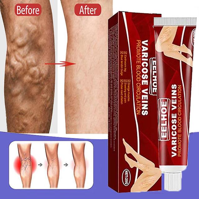 Effective Herbs Cream For Varicose Veins, Vasculitis, Phlebitis, Spider, Institutes, Ointment, Plaster Of Herbs, Beauty, Body Care, 20g 3 pcs on Productcaster.