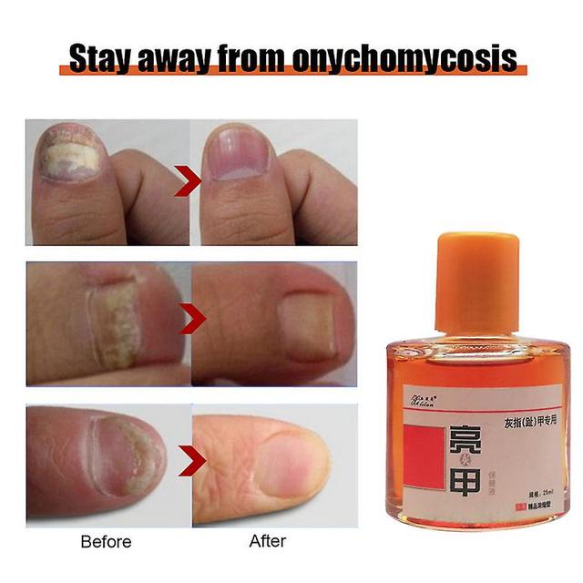 Qian 25ml Bright Nail Health Care Solution To Treat Onychomycosis Boutique Concentrated External Use To Protect Nail Health on Productcaster.