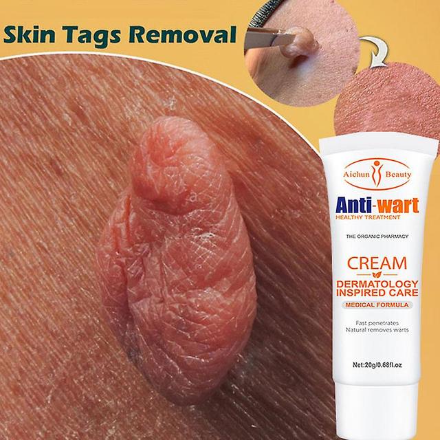 Cream For Removing Warts And Warts, Plant -based Ointments, Care Product For Feet, 20g on Productcaster.